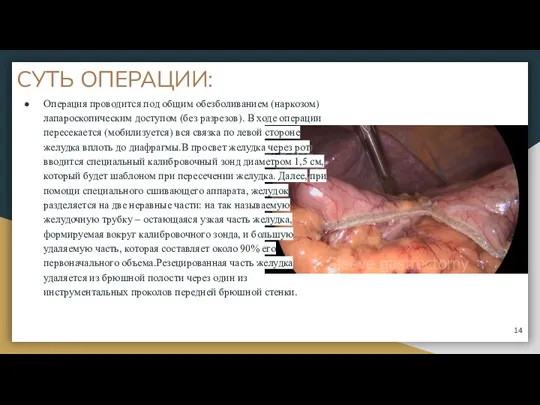 СУТЬ ОПЕРАЦИИ: Операция проводится под общим обезболиванием (наркозом) лапароскопическим доступом (без разрезов).