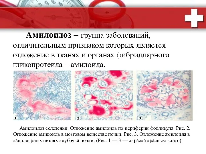 Амилоидоз – группа заболеваний, отличительным признаком которых является отложение в тканях и