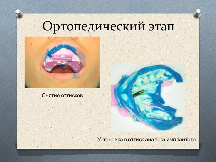 Ортопедический этап Снятие оттисков Установка в оттиск аналога имплантата