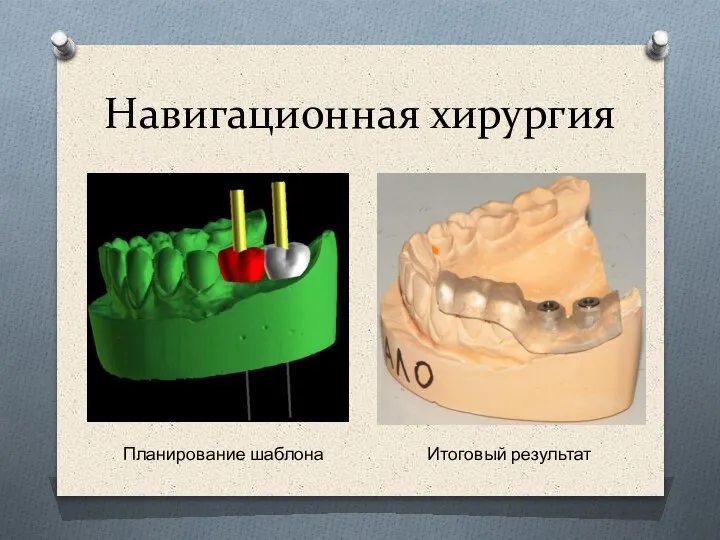 Навигационная хирургия Планирование шаблона Итоговый результат