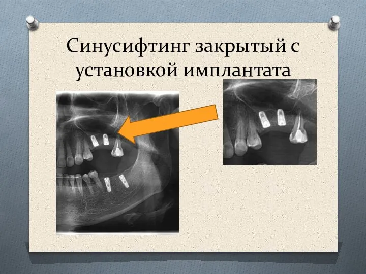 Синусифтинг закрытый с установкой имплантата