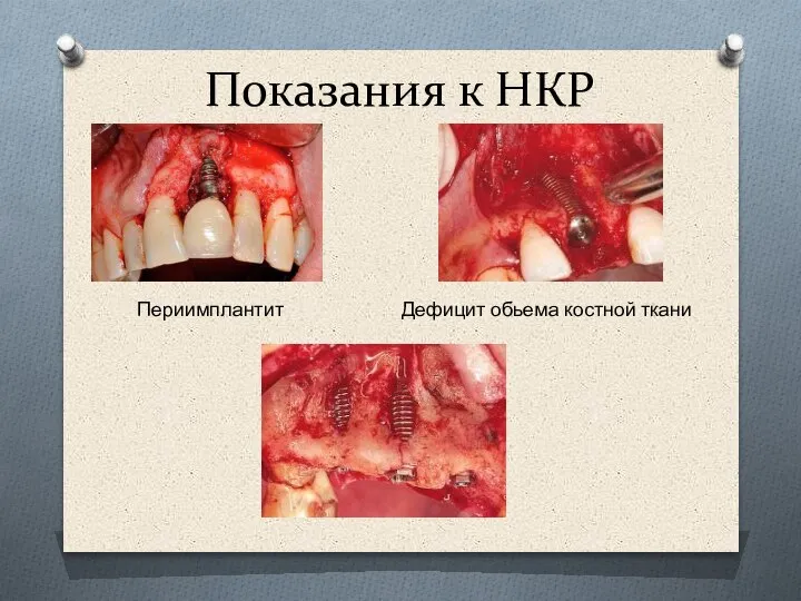 Показания к НКР Периимплантит Дефицит обьема костной ткани