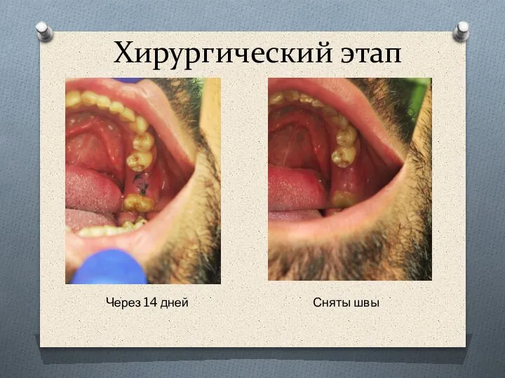 Хирургический этап Через 14 дней Сняты швы