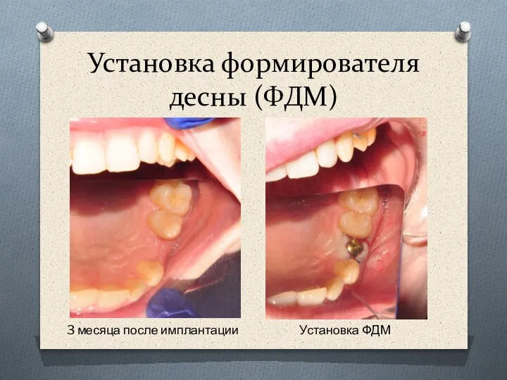 Установка формирователя десны (ФДМ) 3 месяца после имплантации Установка ФДМ