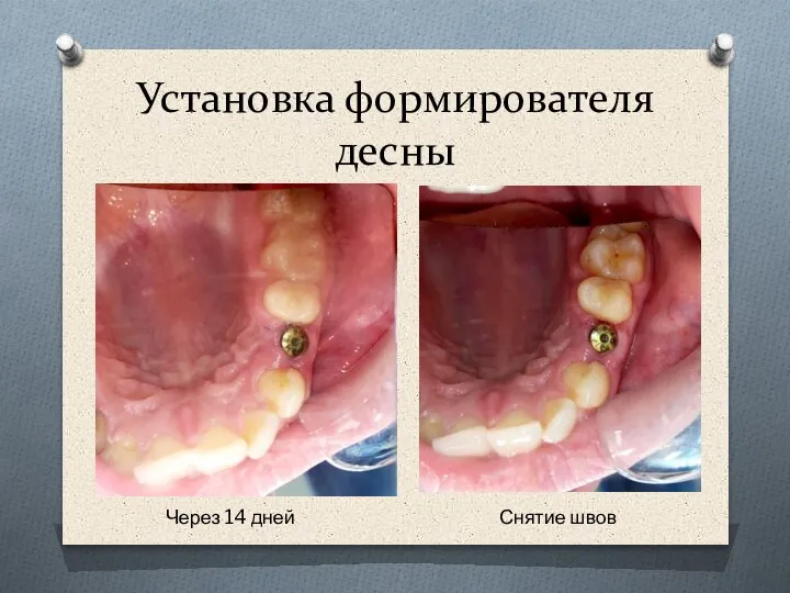 Установка формирователя десны Через 14 дней Снятие швов