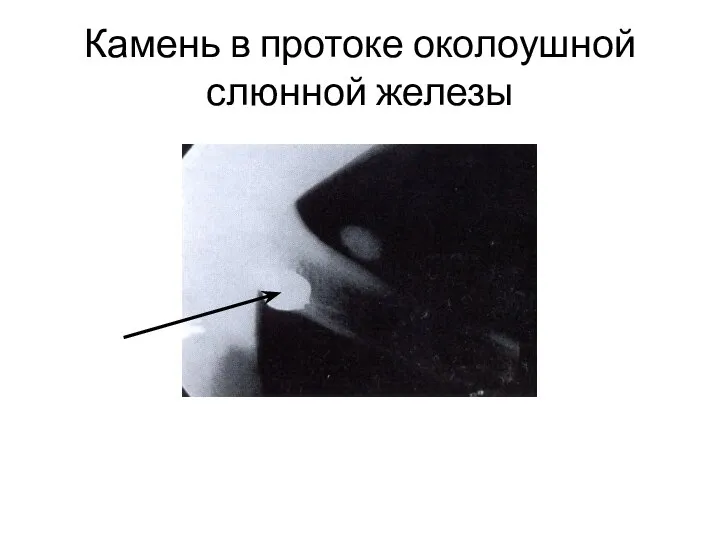 Камень в протоке околоушной слюнной железы