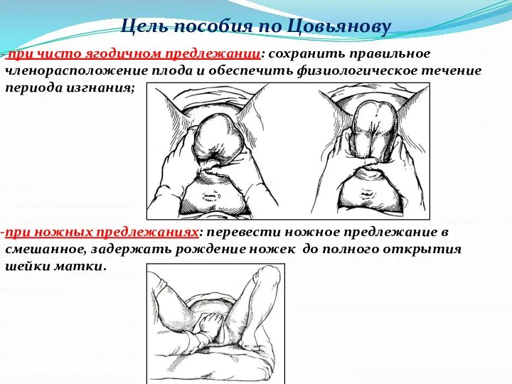 Цель пособия по Цовьянову при чисто ягодичном предлежании: сохранить правильное членорасположение плода