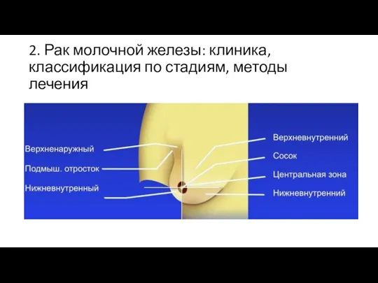 2. Рак молочной железы: клиника, классификация по стадиям, методы лечения