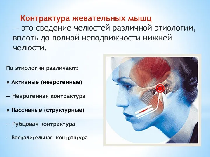 Контрактура жевательных мышц — это сведение челюстей различной этиологии, вплоть до полной
