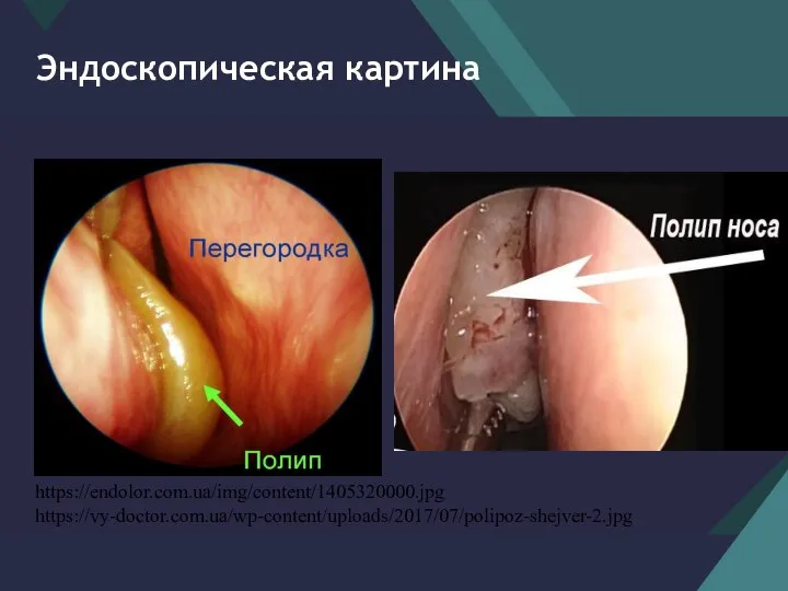 Эндоскопическая картина https://vy-doctor.com.ua/wp-content/uploads/2017/07/polipoz-shejver-2.jpg https://endolor.com.ua/img/content/1405320000.jpg