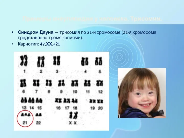 Примеры анеуплоидии у человека. Трисомии. Синдром Дауна — трисомия по 21-й хромосоме