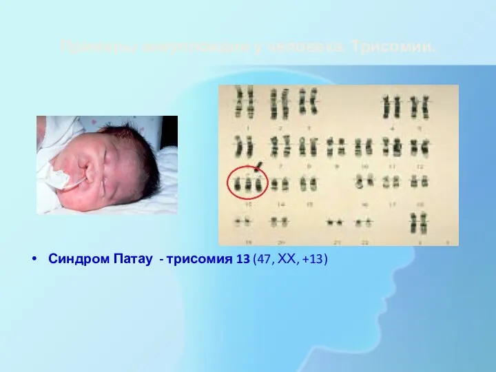 Примеры анеуплоидии у человека. Трисомии. Синдром Патау - трисомия 13 (47, ХХ, +13)