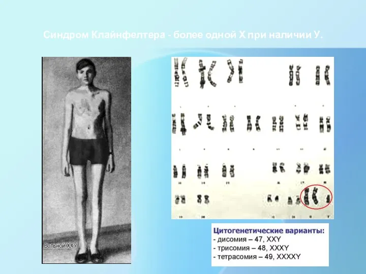 Синдром Клайнфелтера - более одной Х при наличии У.