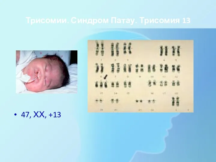 Трисомии. Синдром Патау. Трисомия 13 47, ХХ, +13