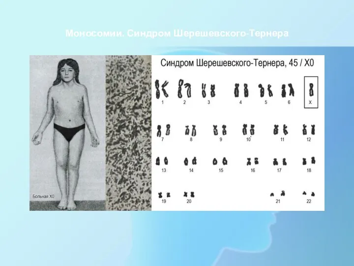 Моносомии. Синдром Шерешевского-Тернера