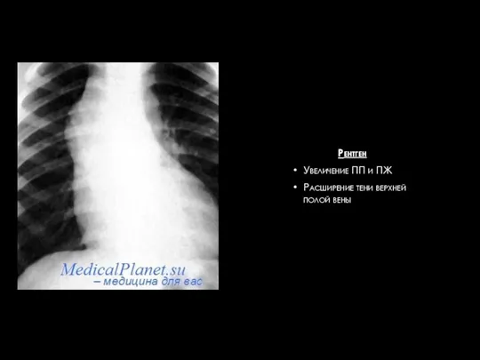 Рентген Увеличение ПП и ПЖ Расширение тени верхней полой вены