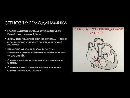 СТЕНОЗ ТК: ГЕМОДИНАМИКА Гемодинамически значимый стеноз менее 3 см. Резкий стеноз –