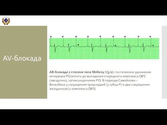 AV-блокада АВ-блокада 2 степени типа Мобитц I (3:2): постепенное удлинение интервала PQ