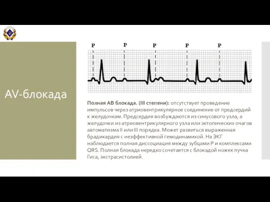 AV-блокада Полная АВ блокада. (III степени): отсутствует проведение импульсов через атриовентрикулярное соединение