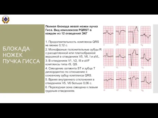 БЛОКАДА НОЖЕК ПУЧКА ГИССА Полная блокада левой ножки пучка Гиса. Вид комплексов