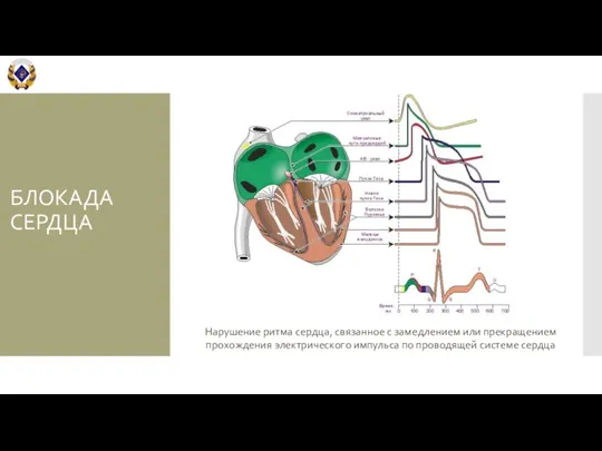 БЛОКАДА СЕРДЦА Нарушение ритма сердца, связанное с замедлением или прекращением прохождения электрического