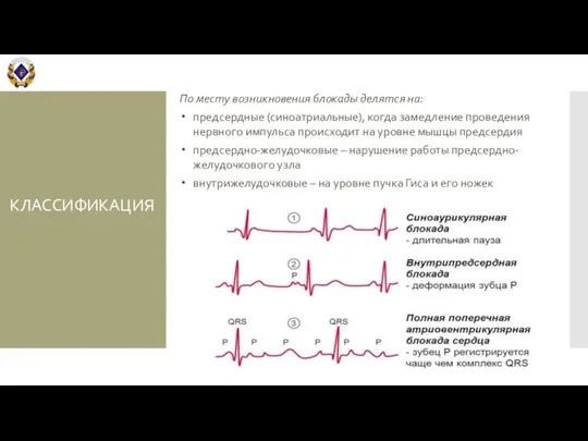 КЛАССИФИКАЦИЯ По месту возникновения блокады делятся на: предсердные (синоатриальные), когда замедление проведения