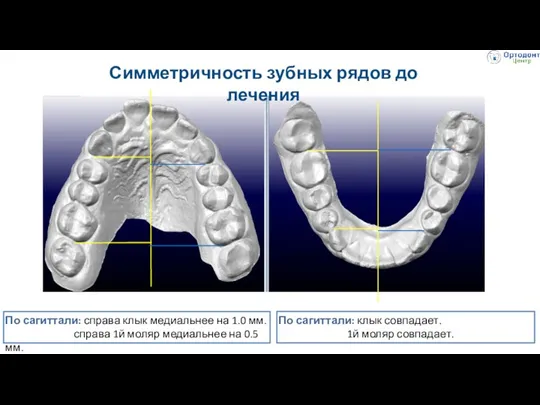 Симметричность зубных рядов до лечения По сагиттали: справа клык медиальнее на 1.0