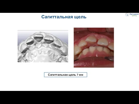 Сагиттальная щель Сагиттальная щель 7 мм