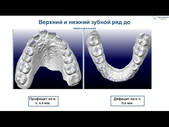 Верхний и нижний зубной ряд до лечения