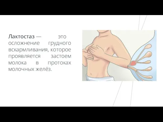 Лактостаз — это осложнение грудного вскармливания, которое проявляется застоем молока в протоках молочных желёз.