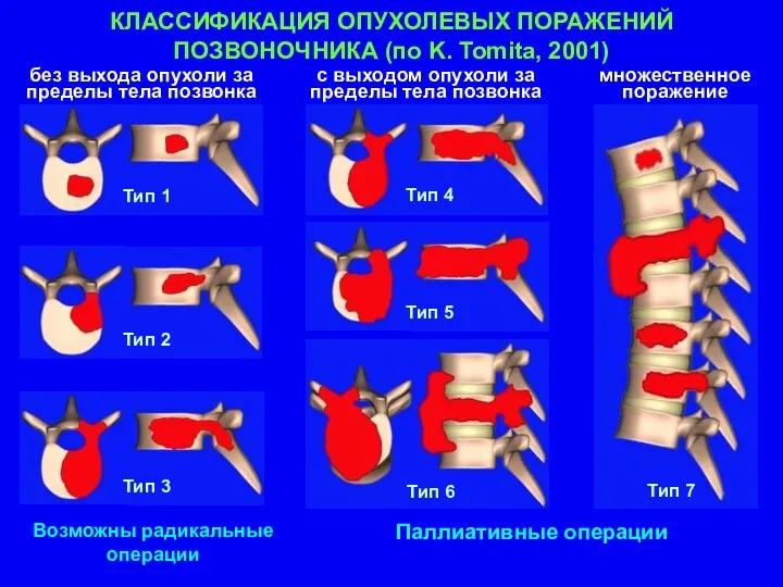 КЛАССИФИКАЦИЯ ОПУХОЛЕВЫХ ПОРАЖЕНИЙ ПОЗВОНОЧНИКА (по K. Tomita, 2001) Возможны радикальные операции Паллиативные операции