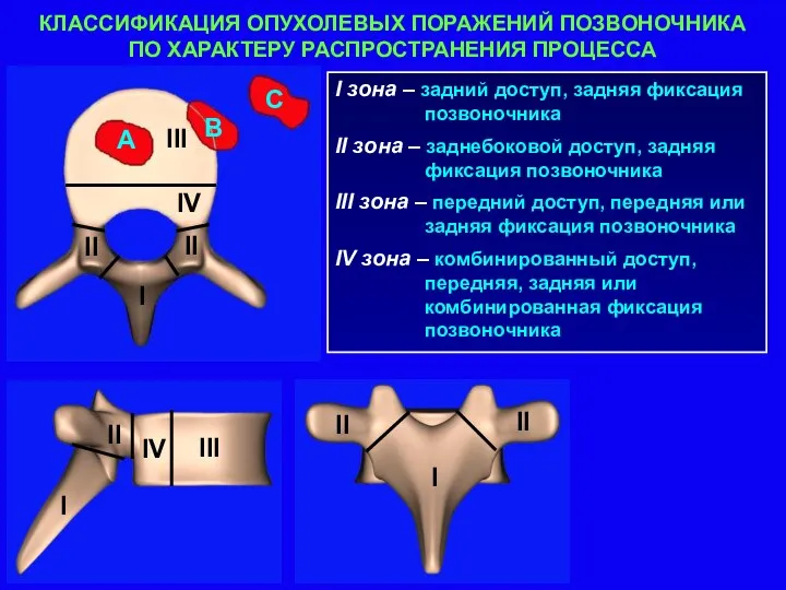 КЛАССИФИКАЦИЯ ОПУХОЛЕВЫХ ПОРАЖЕНИЙ ПОЗВОНОЧНИКА ПО ХАРАКТЕРУ РАСПРОСТРАНЕНИЯ ПРОЦЕССА I зона – задний