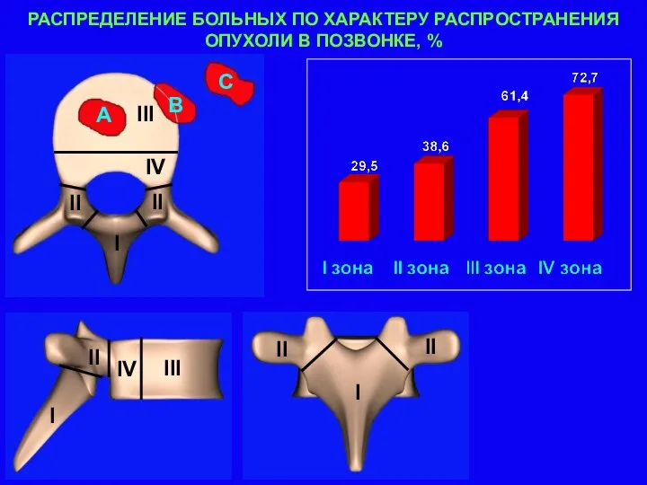 РАСПРЕДЕЛЕНИЕ БОЛЬНЫХ ПО ХАРАКТЕРУ РАСПРОСТРАНЕНИЯ ОПУХОЛИ В ПОЗВОНКЕ, %