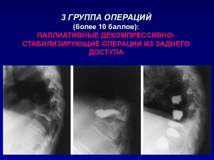 3 ГРУППА ОПЕРАЦИЙ (более 10 баллов): ПАЛЛИАТИВНЫЕ ДЕКОМПРЕССИВНО-СТАБИЛИЗИРУЮЩИЕ ОПЕРАЦИИ ИЗ ЗАДНЕГО ДОСТУПА