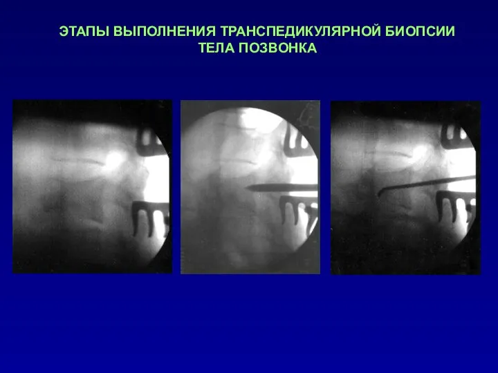 ЭТАПЫ ВЫПОЛНЕНИЯ ТРАНСПЕДИКУЛЯРНОЙ БИОПСИИ ТЕЛА ПОЗВОНКА