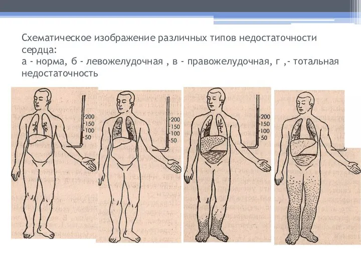 Схематическое изображение различных типов недостаточности сердца: а - норма, б - левожелудочная