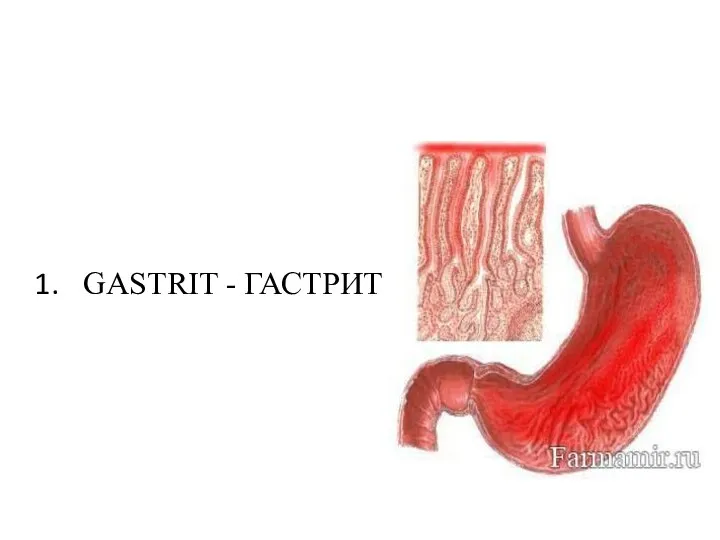 GASTRIT - ГАСТРИТ