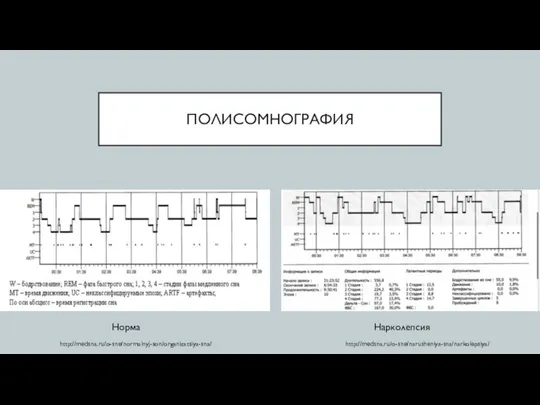 ПОЛИСОМНОГРАФИЯ Норма Нарколепсия http://medsna.ru/o-sne/normalnyj-son/organizatsiya-sna/ http://medsna.ru/o-sne/narusheniya-sna/narkolepsiya/