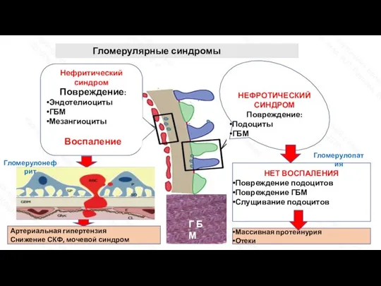 Не Нефритический синдром Повреждение: Эндотелиоциты ГБМ Мезангиоциты Воспаление Реактивная пролиферация резидентных клеток
