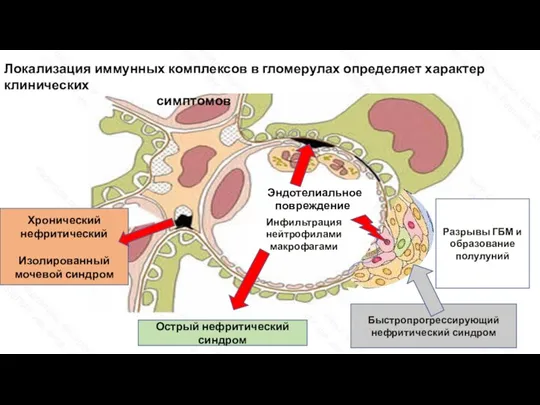 Эндотелиальное повреждение Инфильтрация нейтрофилами макрофагами Острый нефритический синдром Хронический нефритический Изолированный мочевой