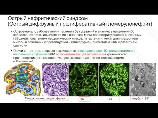 Острый нефритический синдром (Острый диффузный пролиферативный гломерулонефрит) Острое начало заболевания у пациента