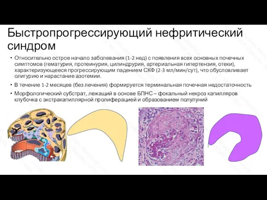 Быстропрогрессирующий нефритический синдром Относительно острое начало заболевания (1-2 нед) с появления всех