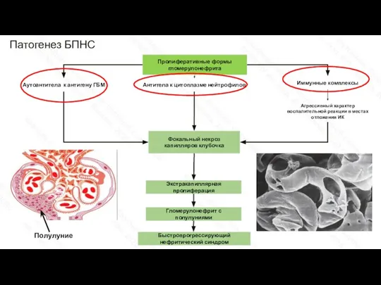 Патогенез БПНС Пролиферативные формы гломерулонефрита Антитела к цитоплазме нейтрофилов Аутоантитела к антигену