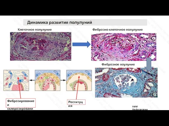 Клеточное полулуние Фиброзно-клеточное полулуние Фиброзное поулуние НИИ Нефрологии Динамика развития полулуний Реституция Фиброзирование и склерозирование