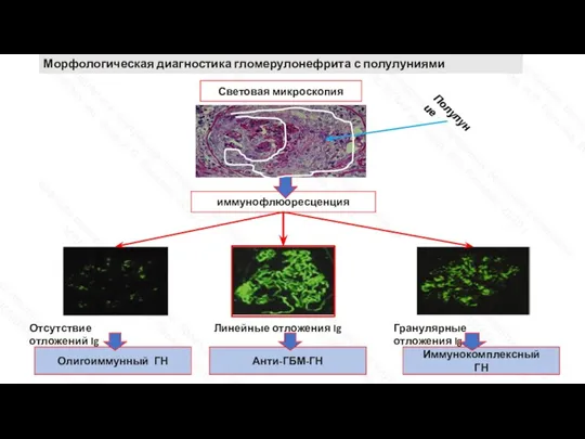 иммунофлюоресценция Отсутствие отложений Ig Линейные отложения Ig Гранулярные отложения Ig Олигоиммунный ГН