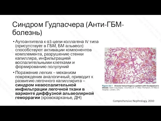 Синдром Гудпасчера (Анти-ГБМ-болезнь) Аутоантитела к α3-цепи коллагена IV типа (присутствует в ГБМ,