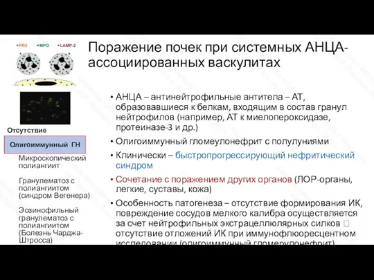 Поражение почек при системных АНЦА-ассоциированных васкулитах АНЦА – антинейтрофильные антитела – АТ,