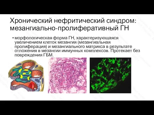 Хронический нефритический синдром: мезангиально-пролиферативный ГН морфологическая форма ГН, характеризующаяся увеличением клеток мезангия