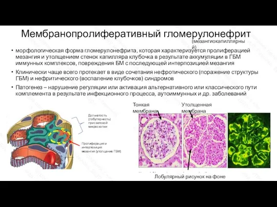 Мембранопролиферативный гломерулонефрит морфологическая форма гломерулонефрита, которая характеризуется пролиферацией мезангия и утолщением стенок