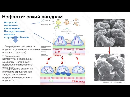 Нефротический синдром 1. Повреждение цитоскелета подоцитов («слияние» вторичных ножковых отростков) 2. Повреждение